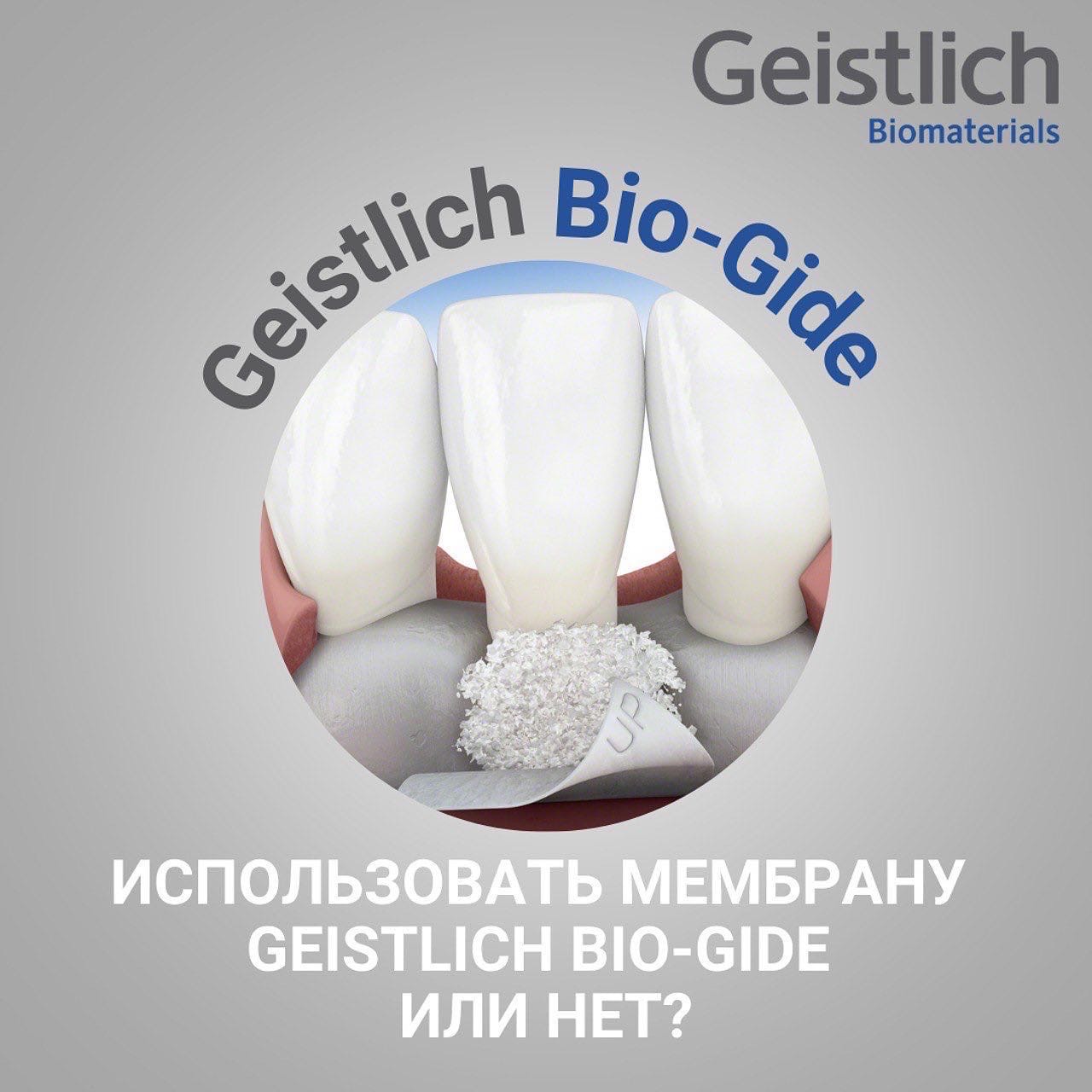 Комбинация Geistlich Bio-Gide, Geistlich Bio-Оss и деривата эмалевого матрикса